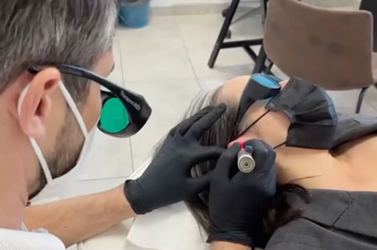 Cómo funciona una sesión de láser para dejar de fumar