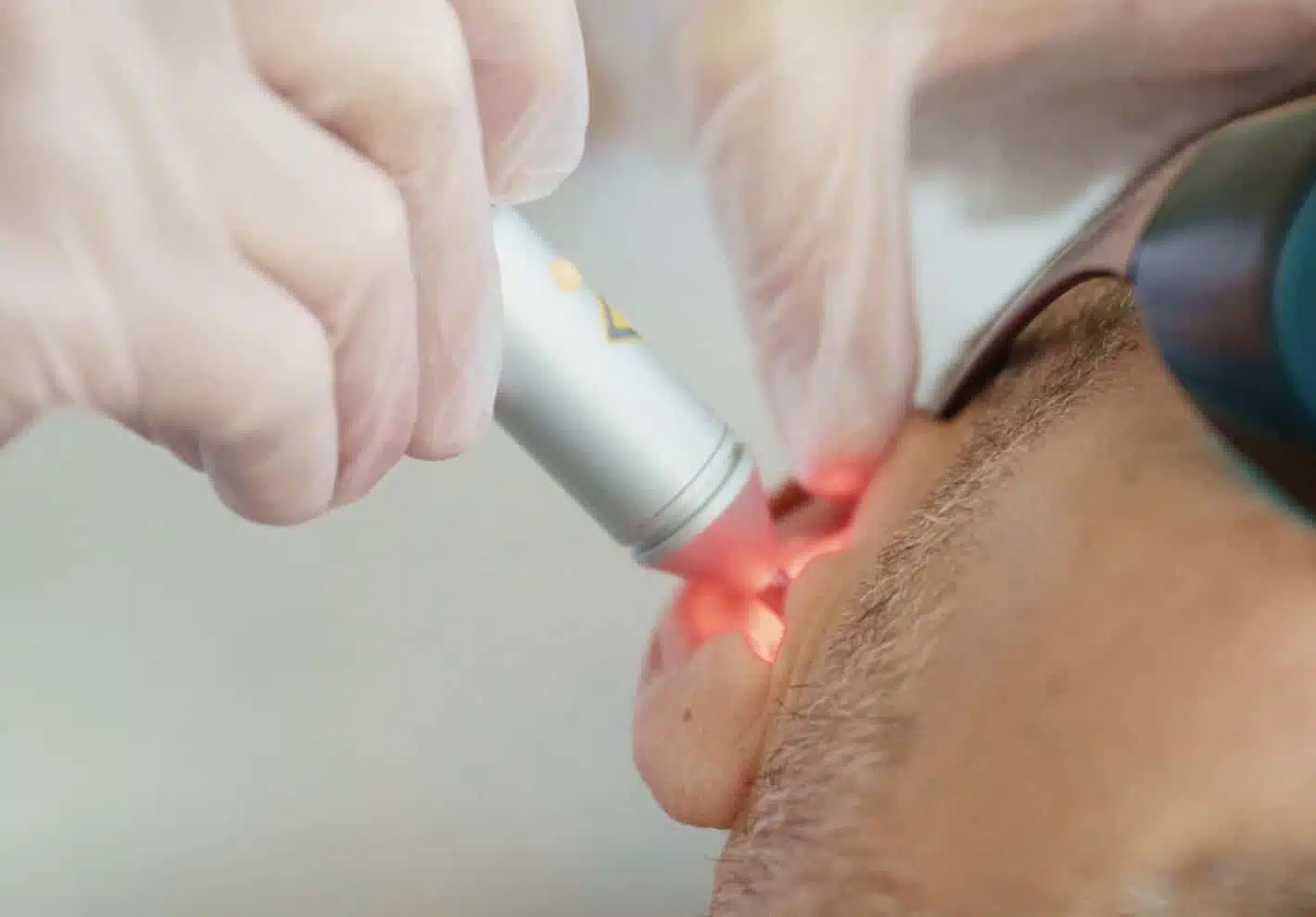 auriculoterapia láser laserOstop dejar de fumar abandono del tabaco